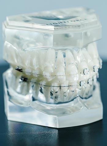 lightforce orthodontics